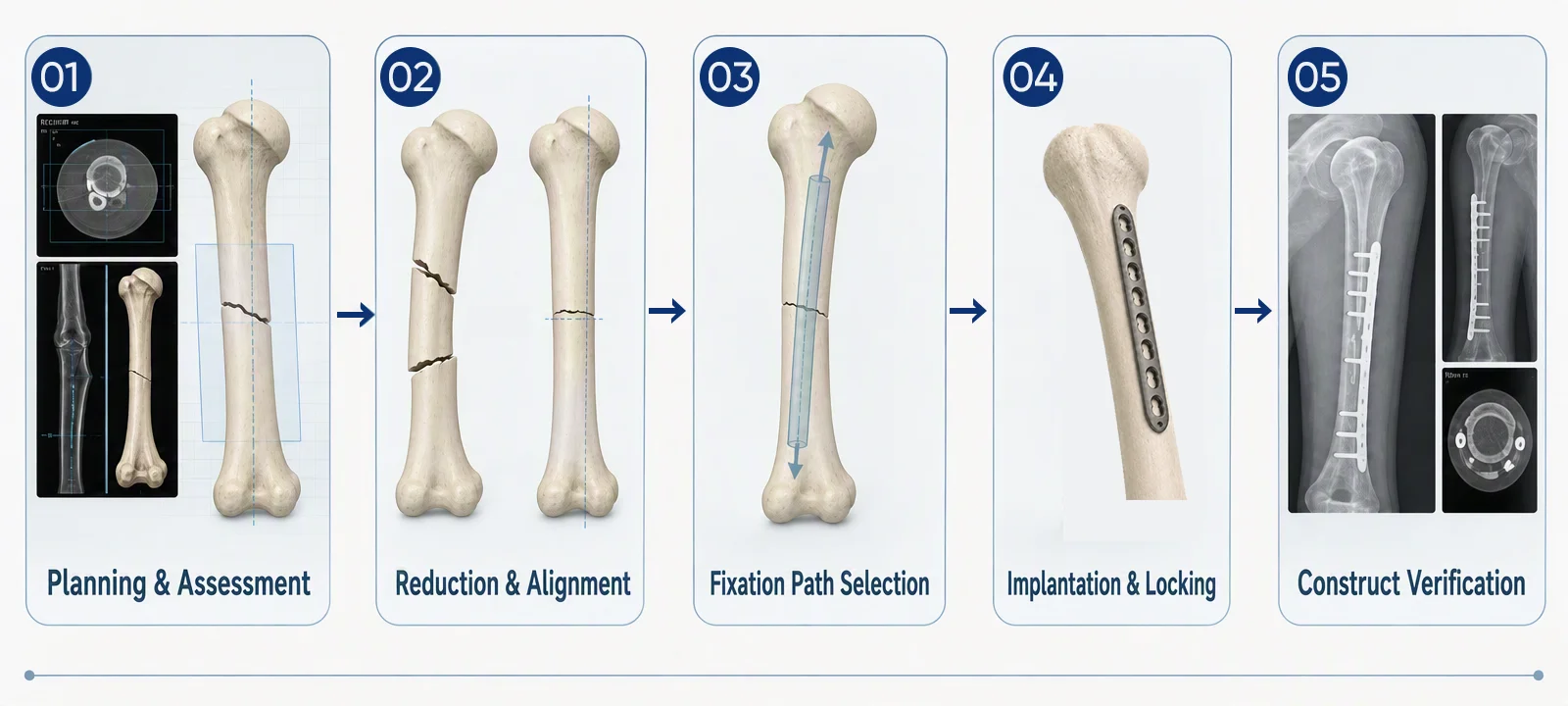 High-level workflow for humeral shaft fixation