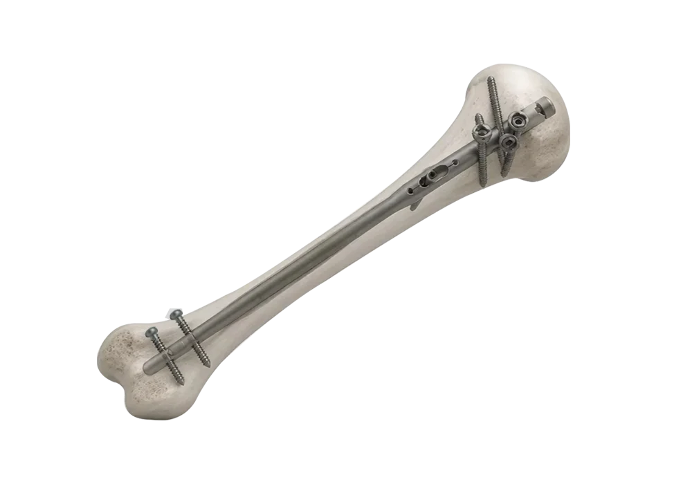 Humerus Multi Lock intramedullary nail fixation route