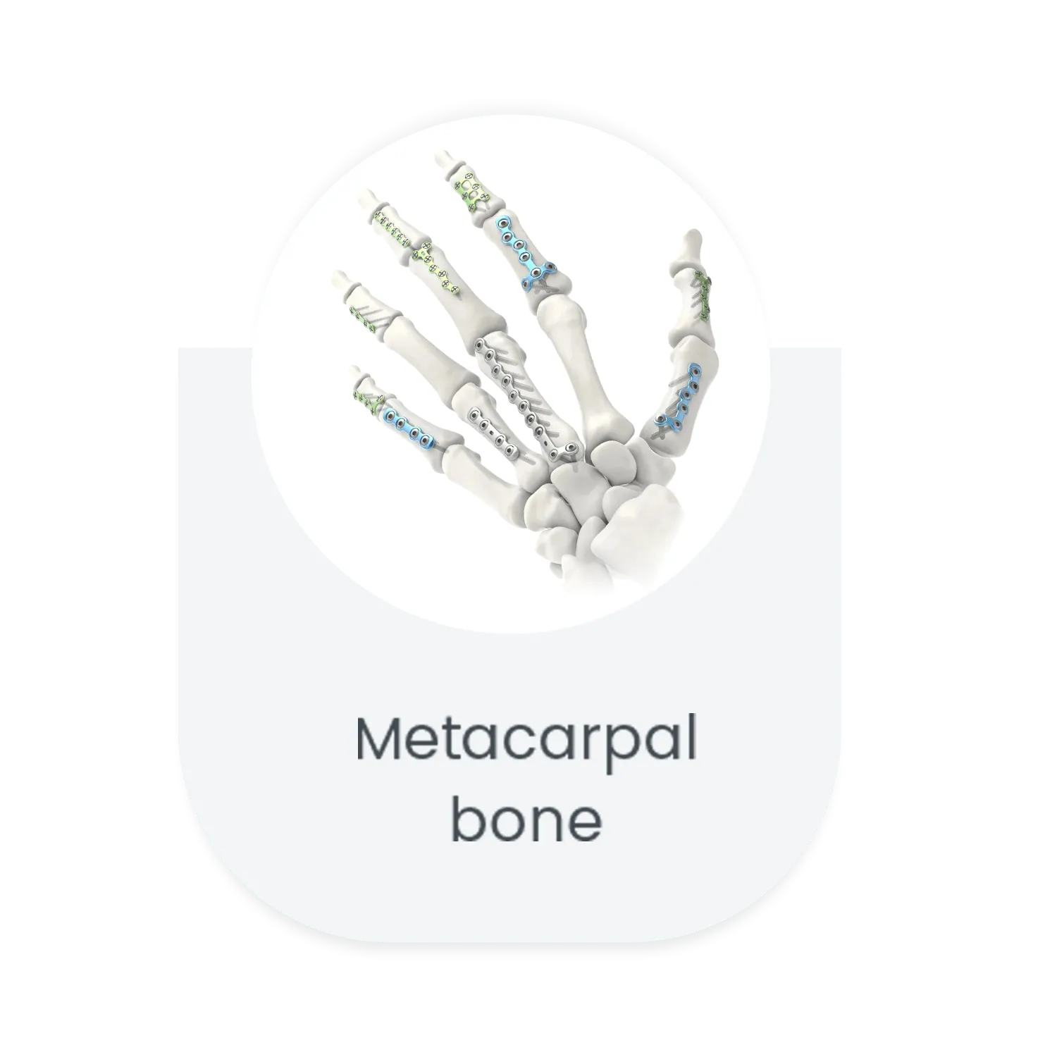 Metacarpal bone locking plate system