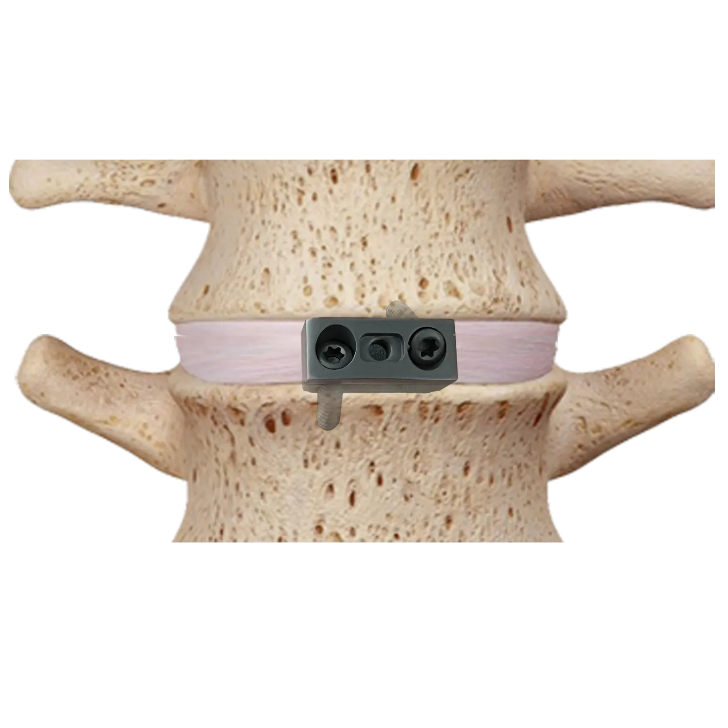 Cervical Titanium Cage-IV placement in the cervical interbody space