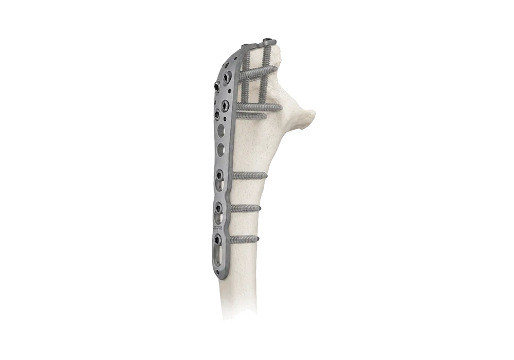 L&agrave;lan'ny takelaka fanidiana ho an'ny fametahana ulna proximal