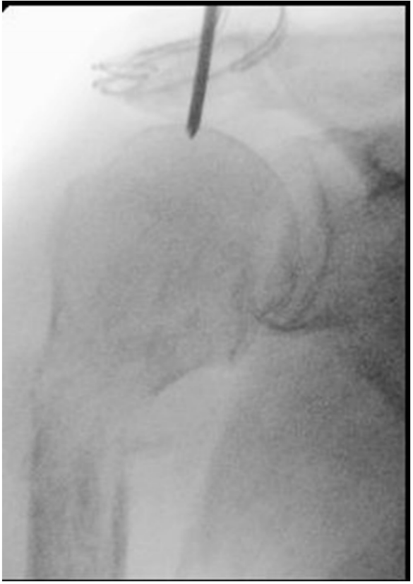 Identification of the medullary nail entry point just medial to the supraspinous fossa