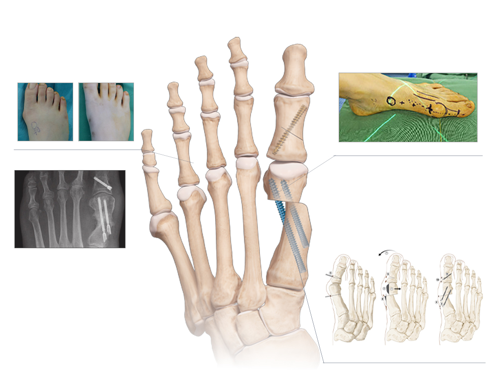 Pre- and Postoperative Appearance, Advanced Cannulated Screw Design, Minimally Invasive Correction