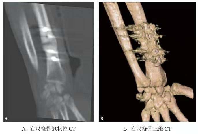 Representative CT image of distal radius fracture with plate fixation artifact