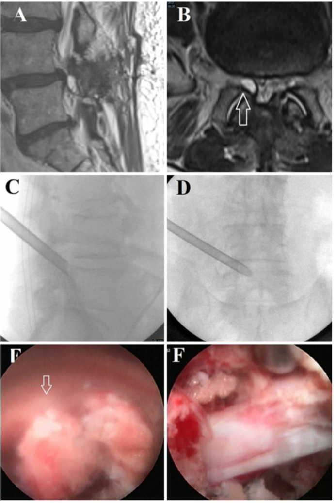 MRI fluoroscopy and endoscopic images of lumbar facet joint cyst decompression