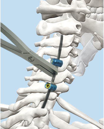 Rod rotation method illustration