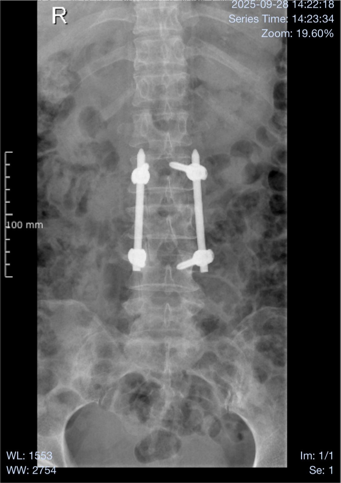 X-ray showing XC Medico Spinal Internal Fixation System