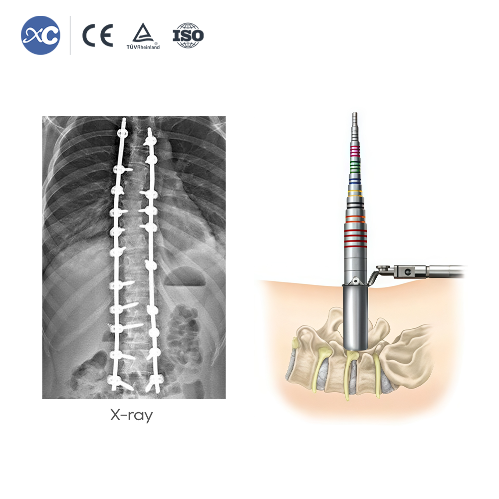 5.5 MIS Spinal System II Instrument Set | XC Medico