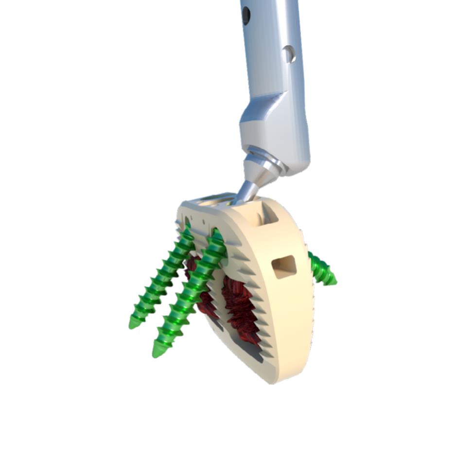 Completed ALIF cage screw fixation