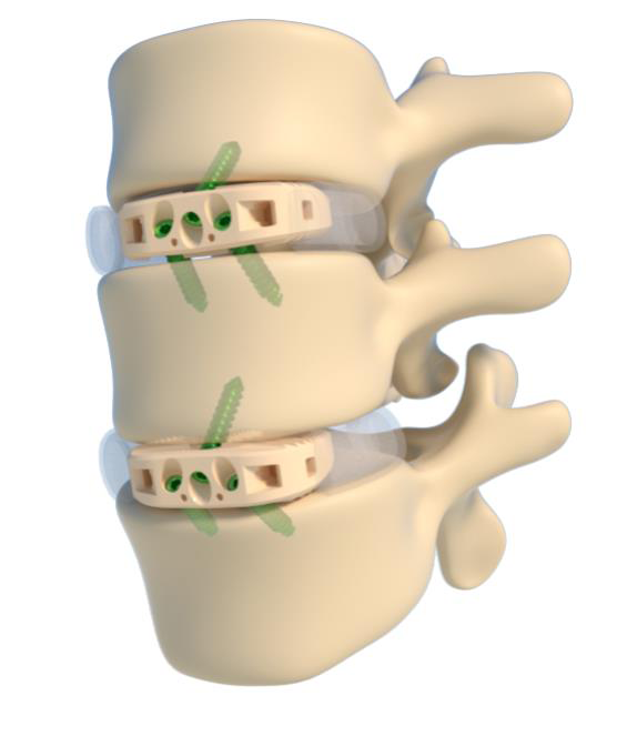 Stand-alone ALIF PEEK cage implanted in the lumbar spine