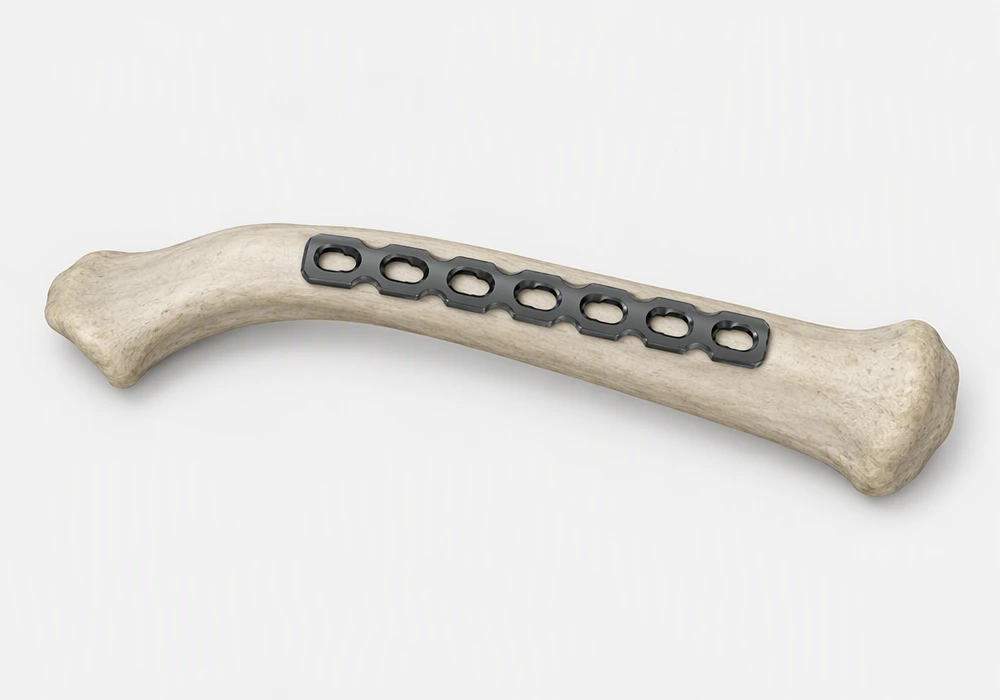 Clavicle reconstruction plate solution