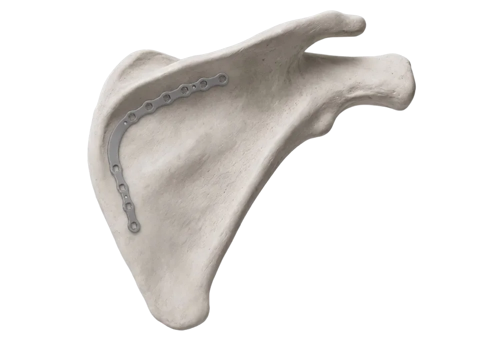 Medial scapula fracture fixation