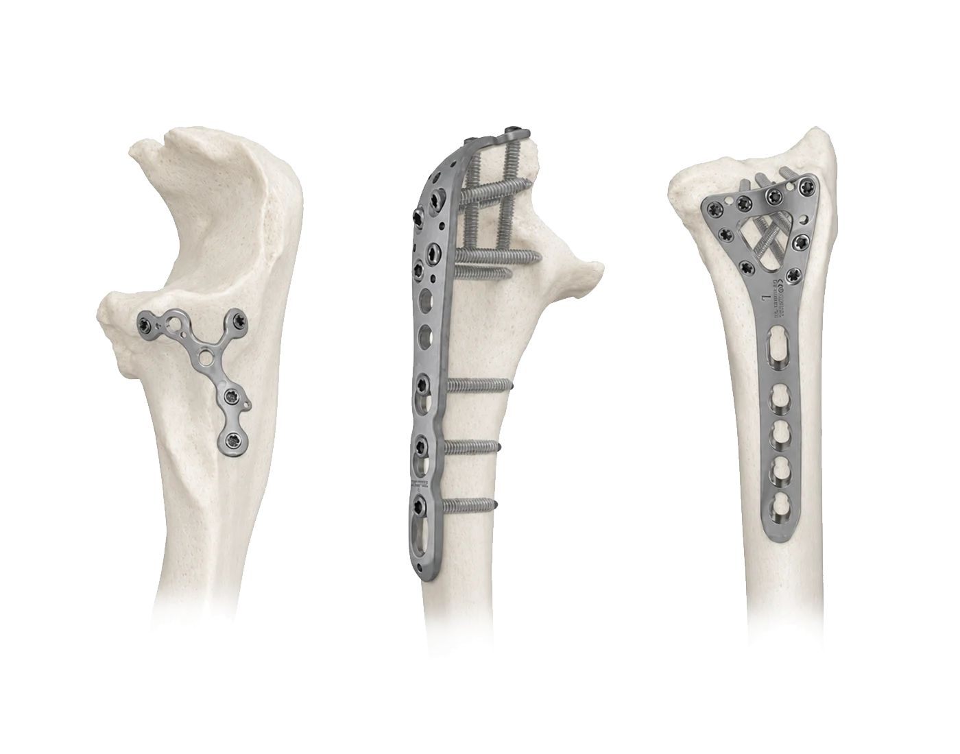Olecranon sy proximal ulna fixation rafitra