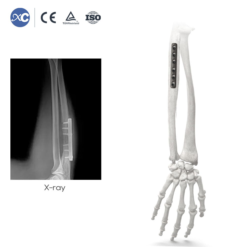 Set instrumenata za zaključavanje malih fragmenata - XC Medico