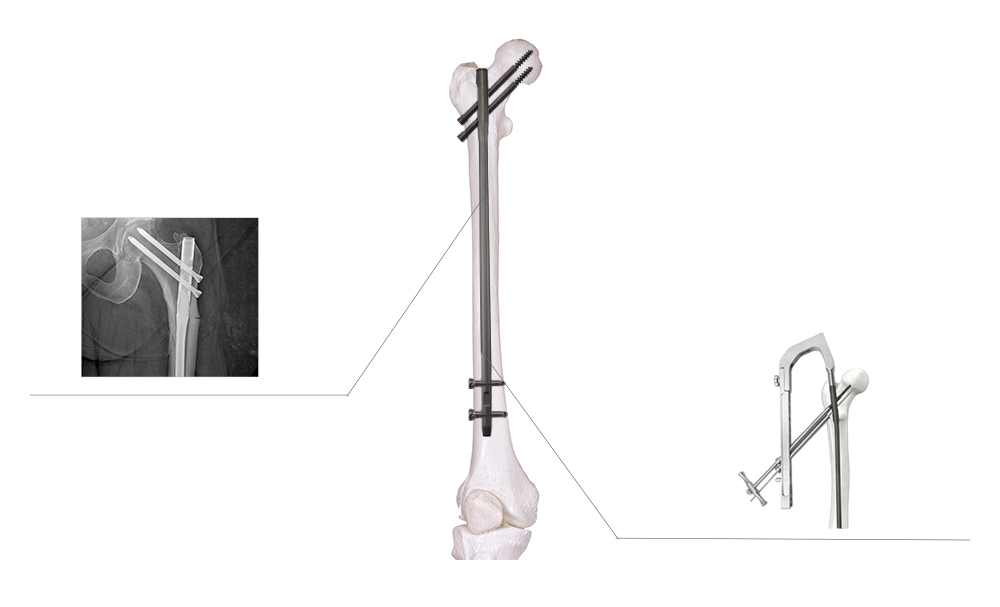 Femoral Nail Fixation Dynamics and Proximal Optimization