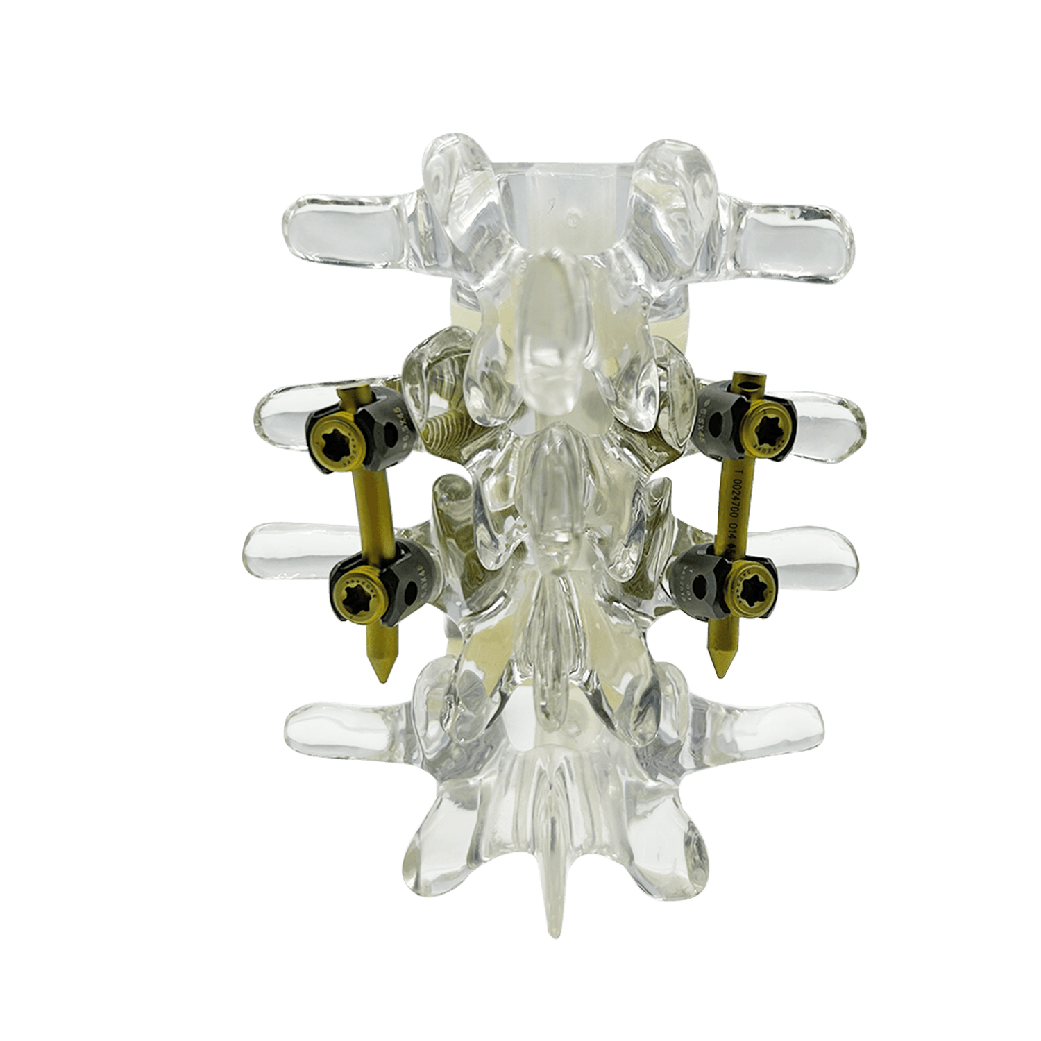 Cement-augmented MIS-TLIF construct with fenestrated pedicle screws