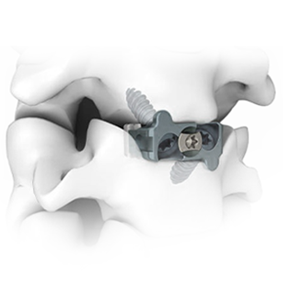Zero-profile cervical cage with integrated screw fixation
