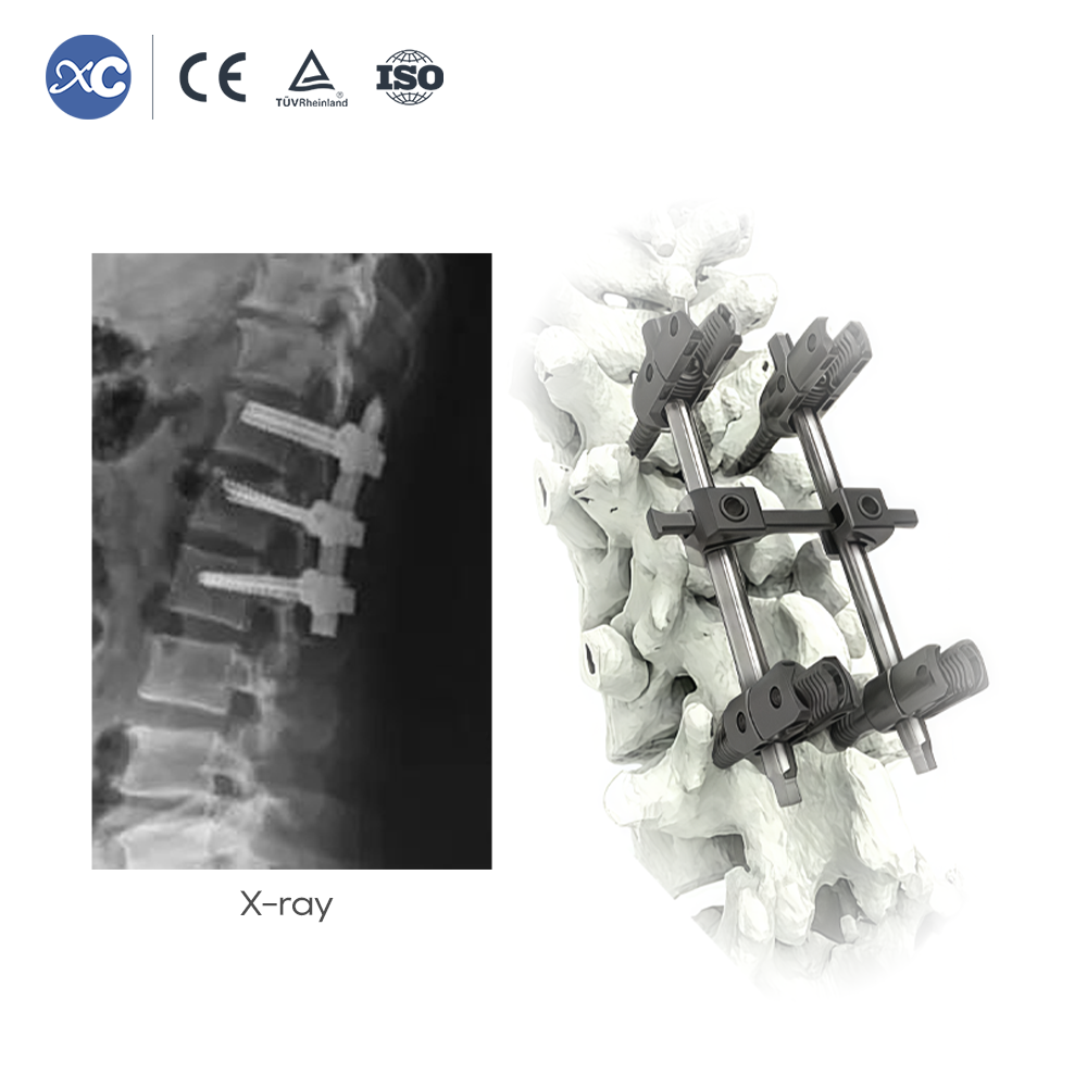 5.5 Reduction Pedicle Screw | Spinal Fixation | XC Medico