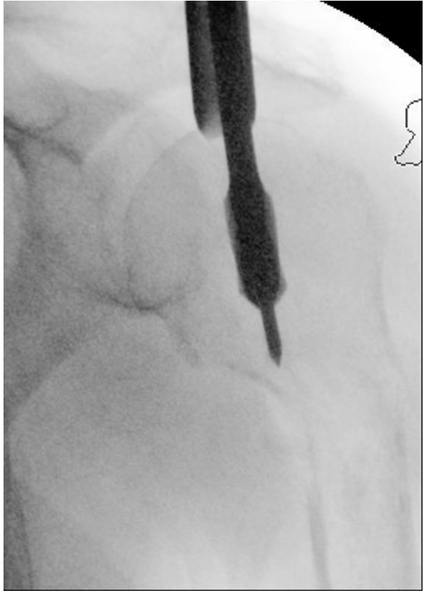 High-speed burr creating the medullary canal pathway from proximal to distal humerus