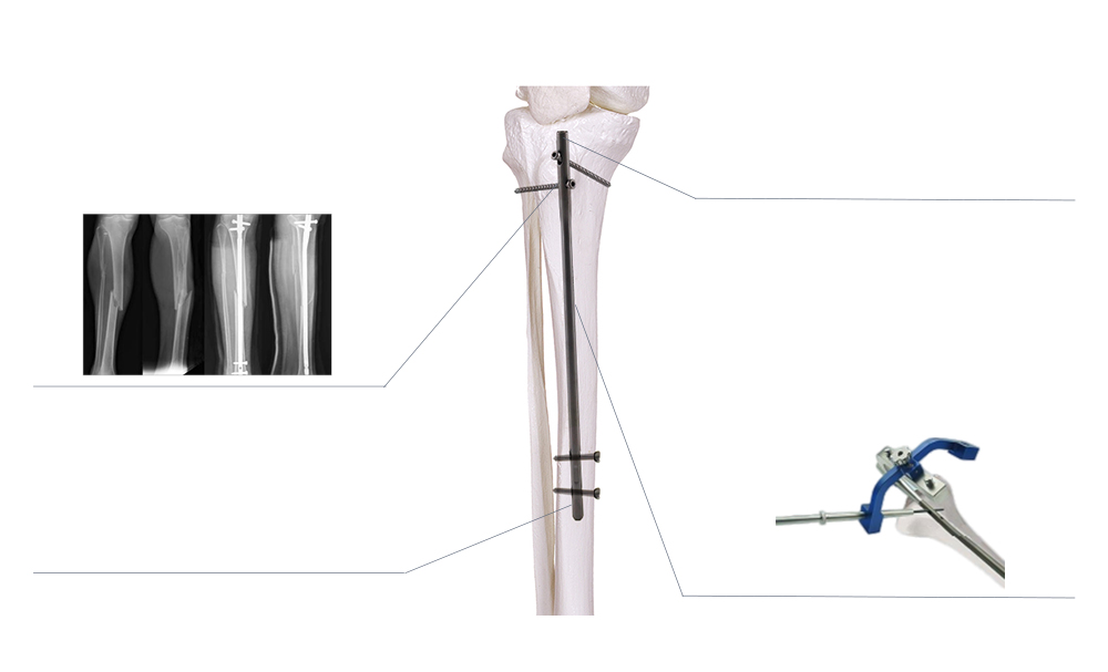 Intramedullary Central Fixation and Minimally Invasive Healing Mechanics