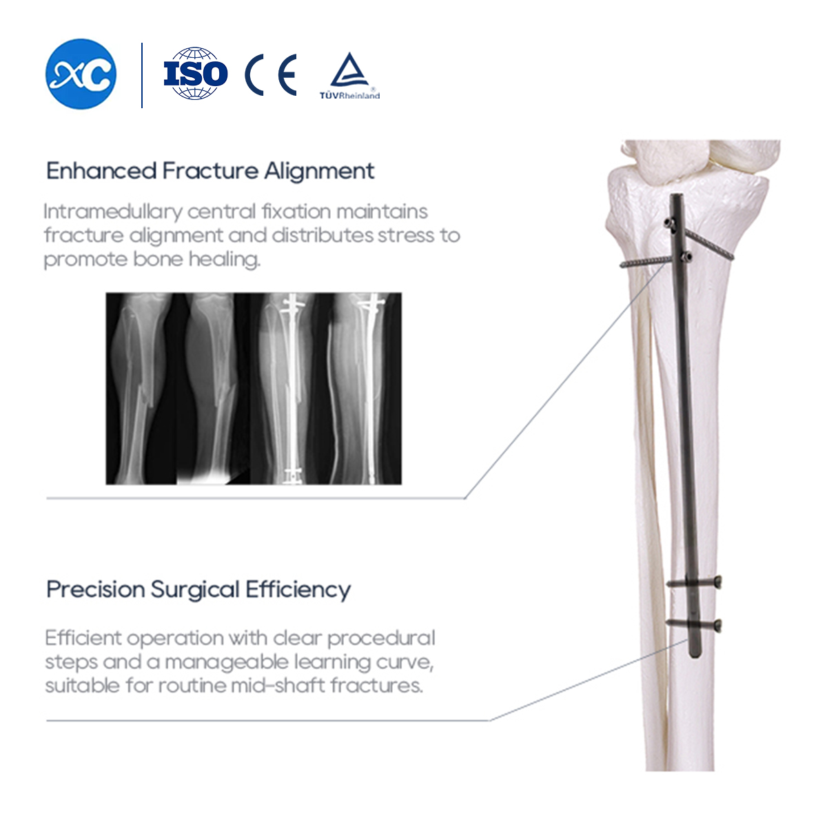 Tibial Intramedullary Nail | Tibia Fracture Fixation | XC Medico