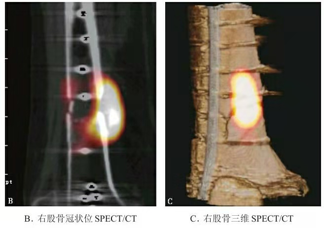Representative SPECT/CT showing metabolic activity near femoral fracture site