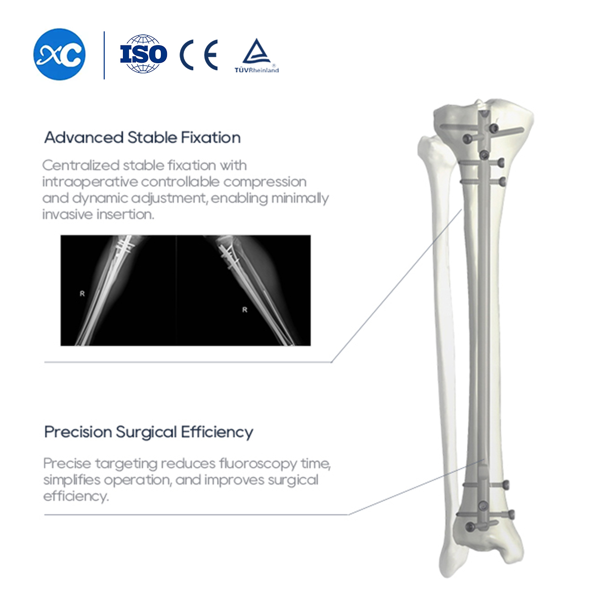 Tshiab Tibia Intramedullary Nail | Orthopedic Fixation | XC Medico