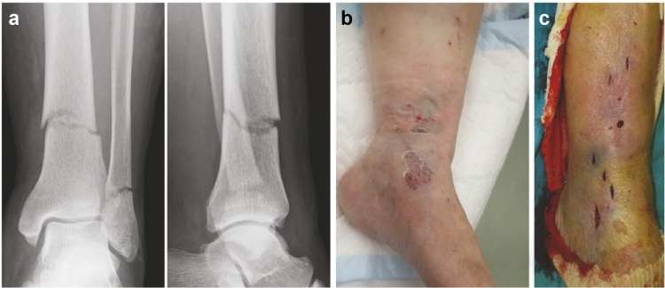 Clinical photograph of severe soft tissue trauma and swelling following motor vehicle crush injury to distal tibia