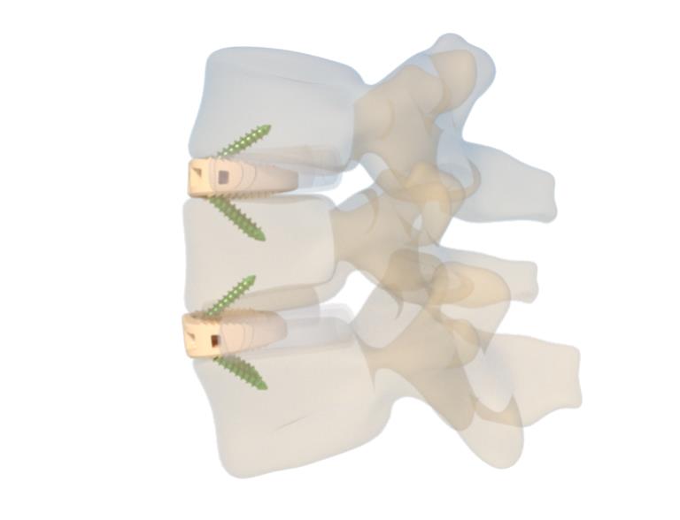 Lateral view of final ALIF cage placement