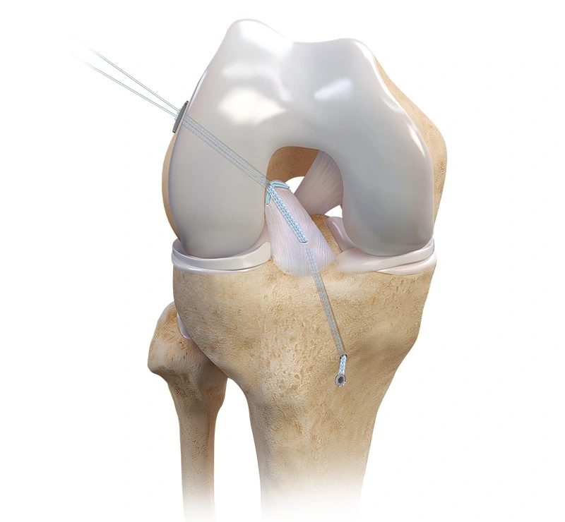 Arthrex ACL reconstruction illustration showing suspensory fixation