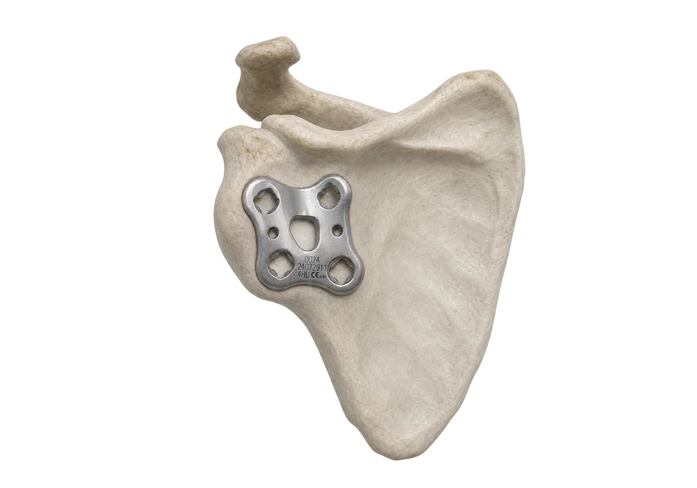 Glenoid cavity fracture fixation