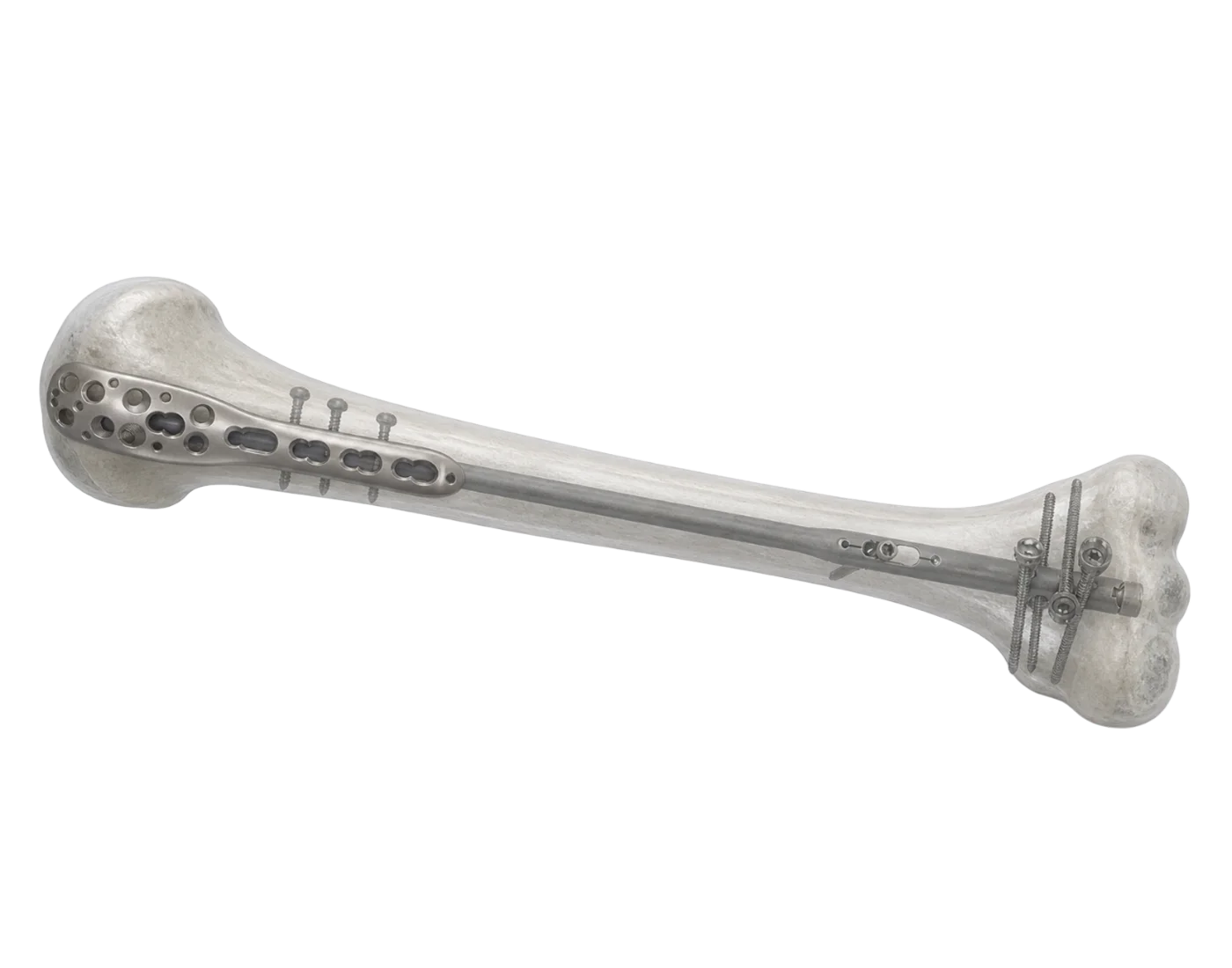 Proximal humerus fracture fixation systems