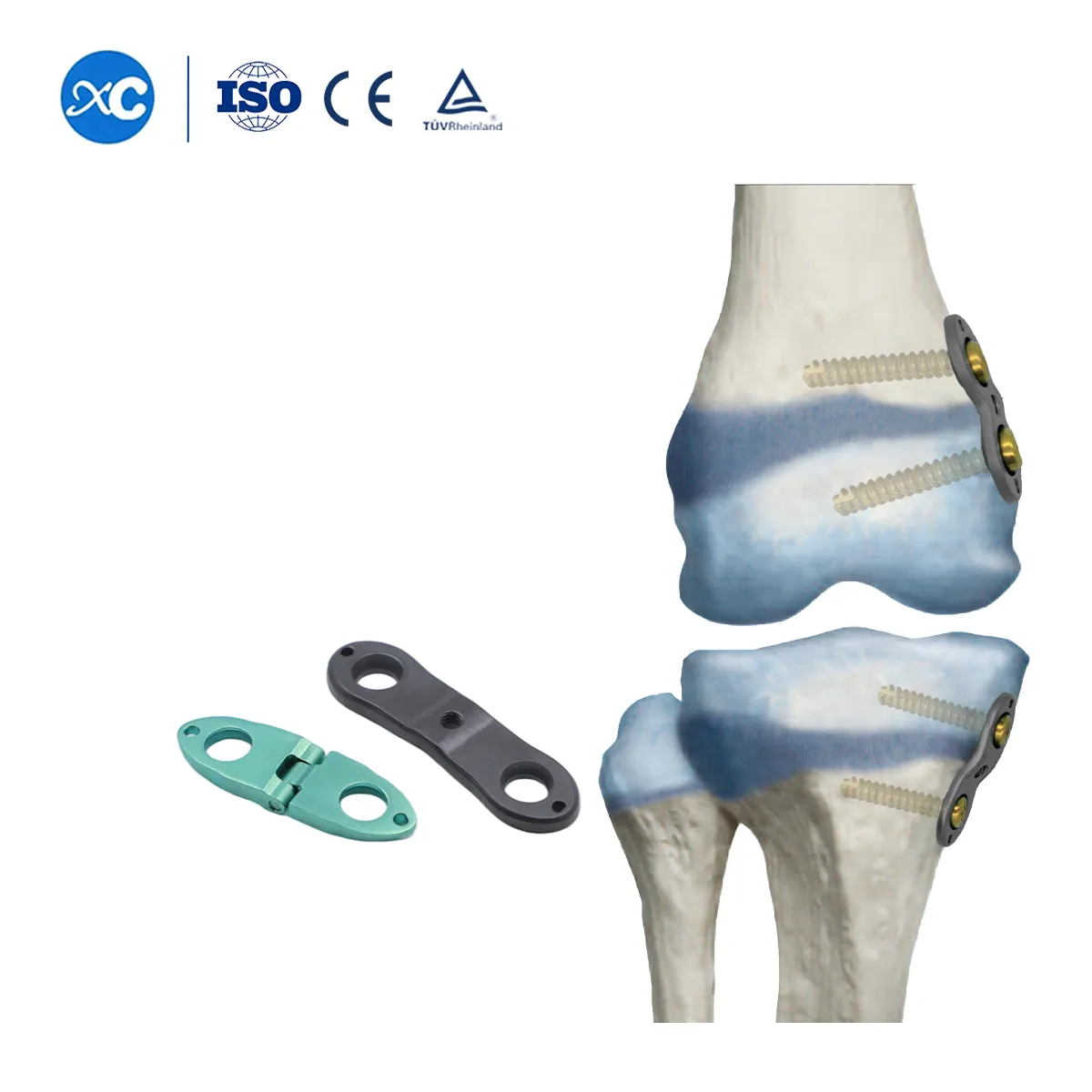 Pediatric Valgus Varus Orthopedic System | Limb Deformity Correction Implant- 4