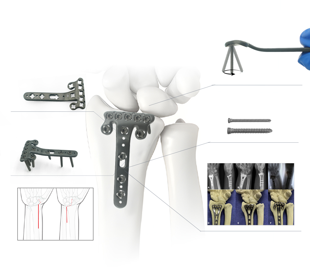 Distal Radius Plate Product Details and Clinical X-Ray Comparison