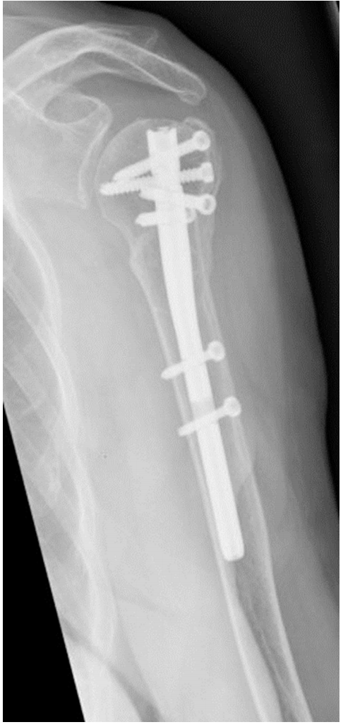Two-year follow-up anteroposterior radiograph showing complete fracture healing and stable hardware