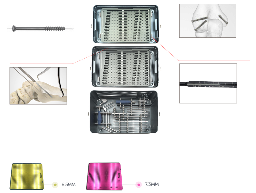 6.5/7.3 Cannulated Screw Compression Fixation and Depth Measurement