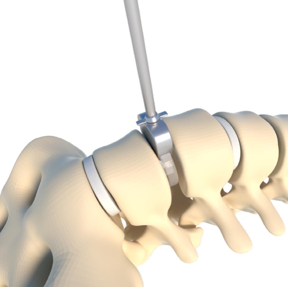 ALIF trial implant insertion
