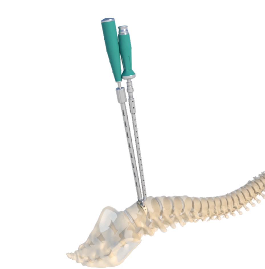 ALIF pre-loading wrench and handle