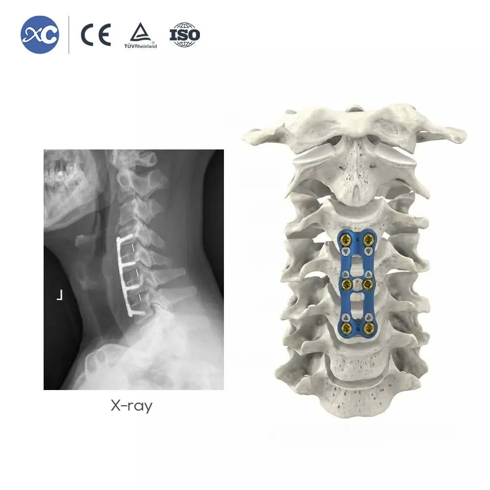 0.8mm Ultra-Thin Anterior Cervical Plate | Cervical Fixation System - 5