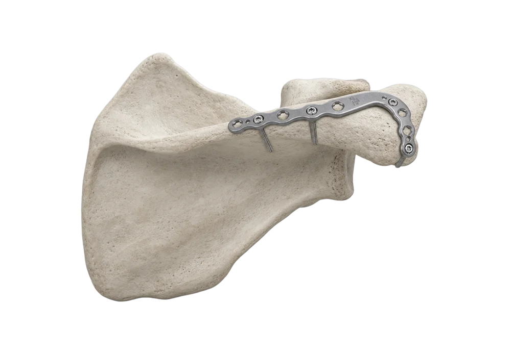 Acromion of scapula fracture fixation