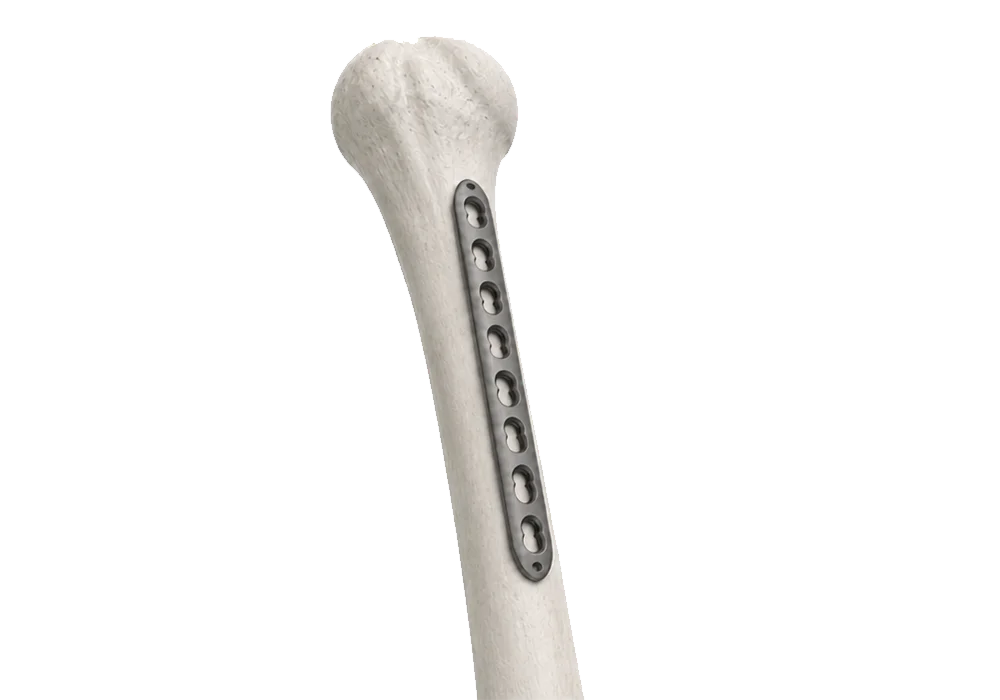 Locking plate pathway for humeral shaft fixation