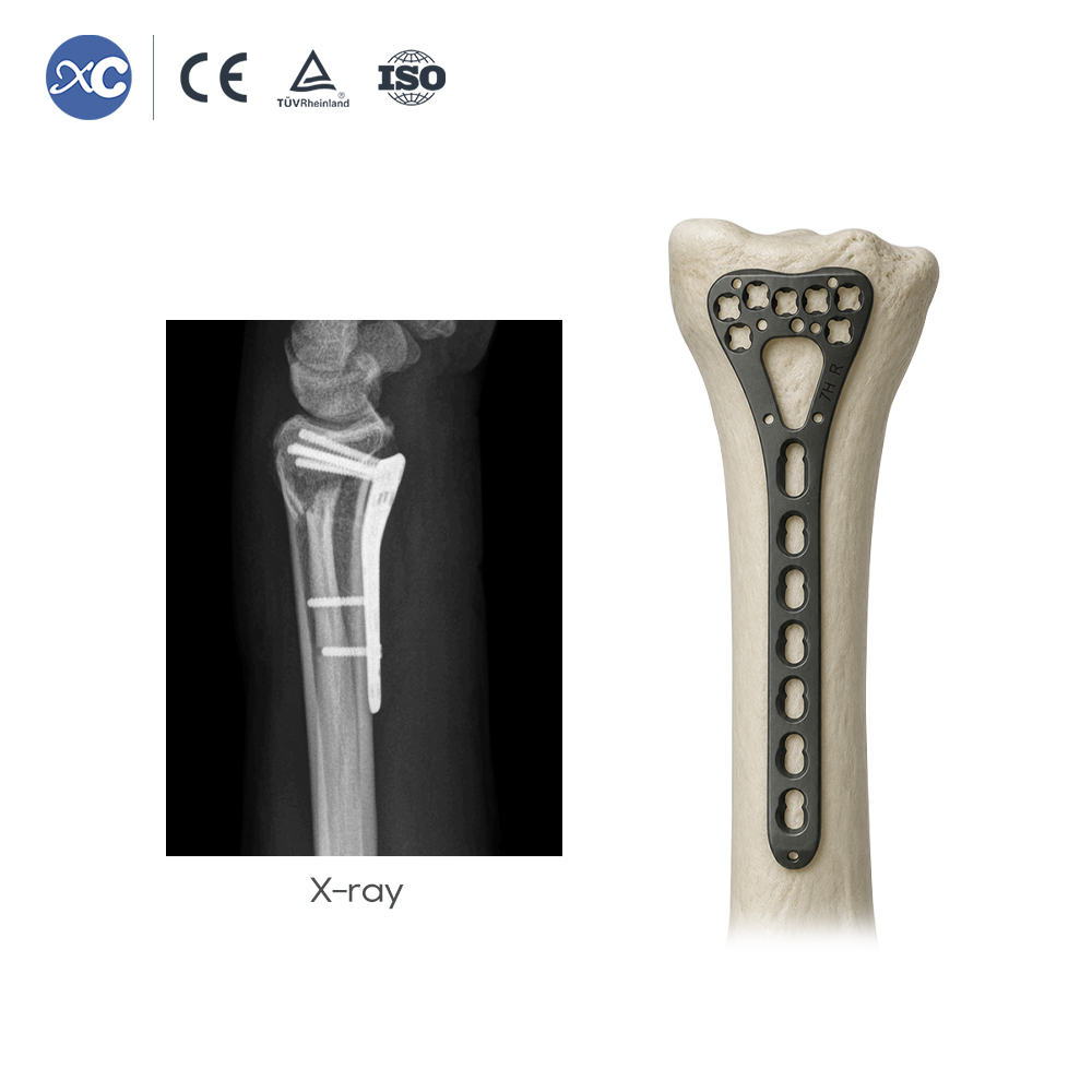 Distal Radius Locking Plate (7 Holes) - XC Medico - 3