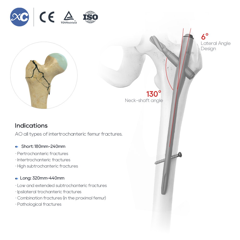 PFNA интрамедуларен пирон | Фиксиране на фрактура на проксимална бедрена кост