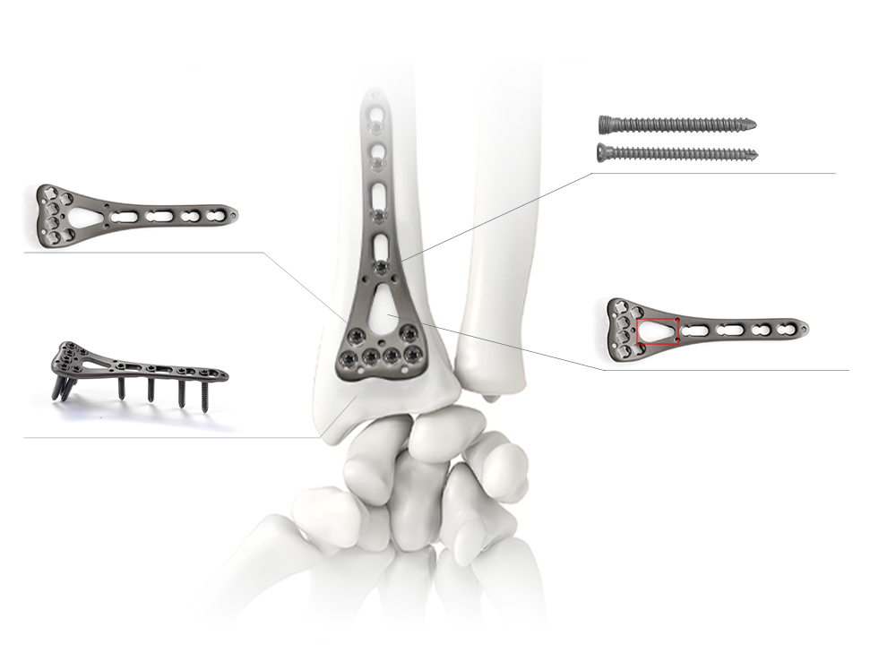 Mion-fhiosrachadh mu dhealbhadh anatomical air siostam pl&agrave;ta radius distal