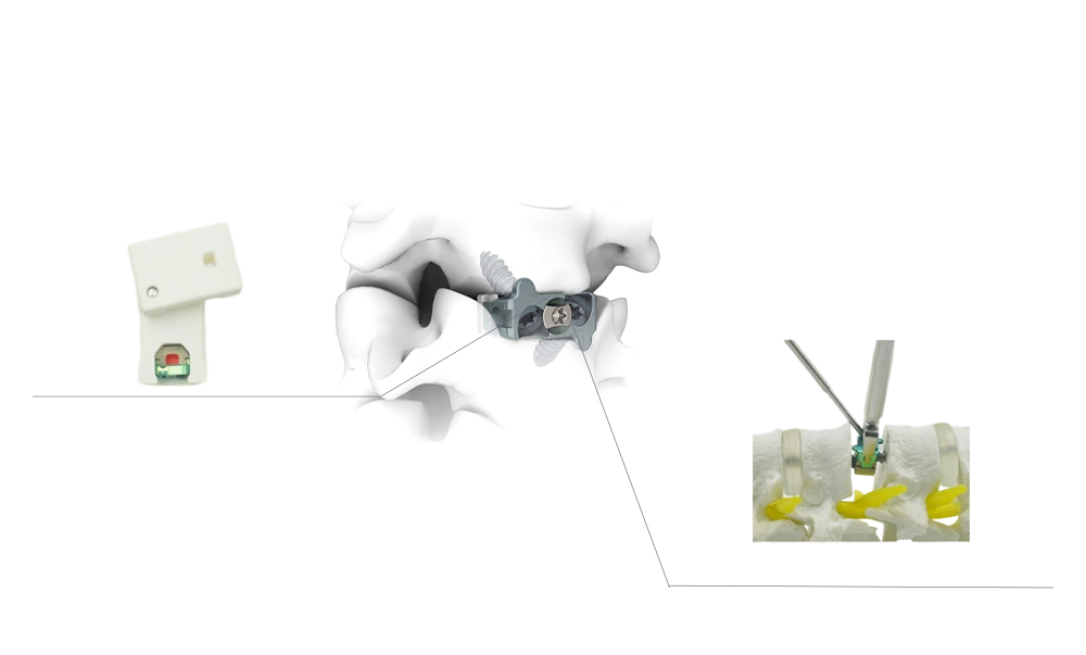 Zero profile cervical PEEK cage product details with integrated locking screws