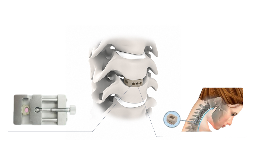 Cervical PEEK Cage II Biomechanics and Spinal Anatomy Fit