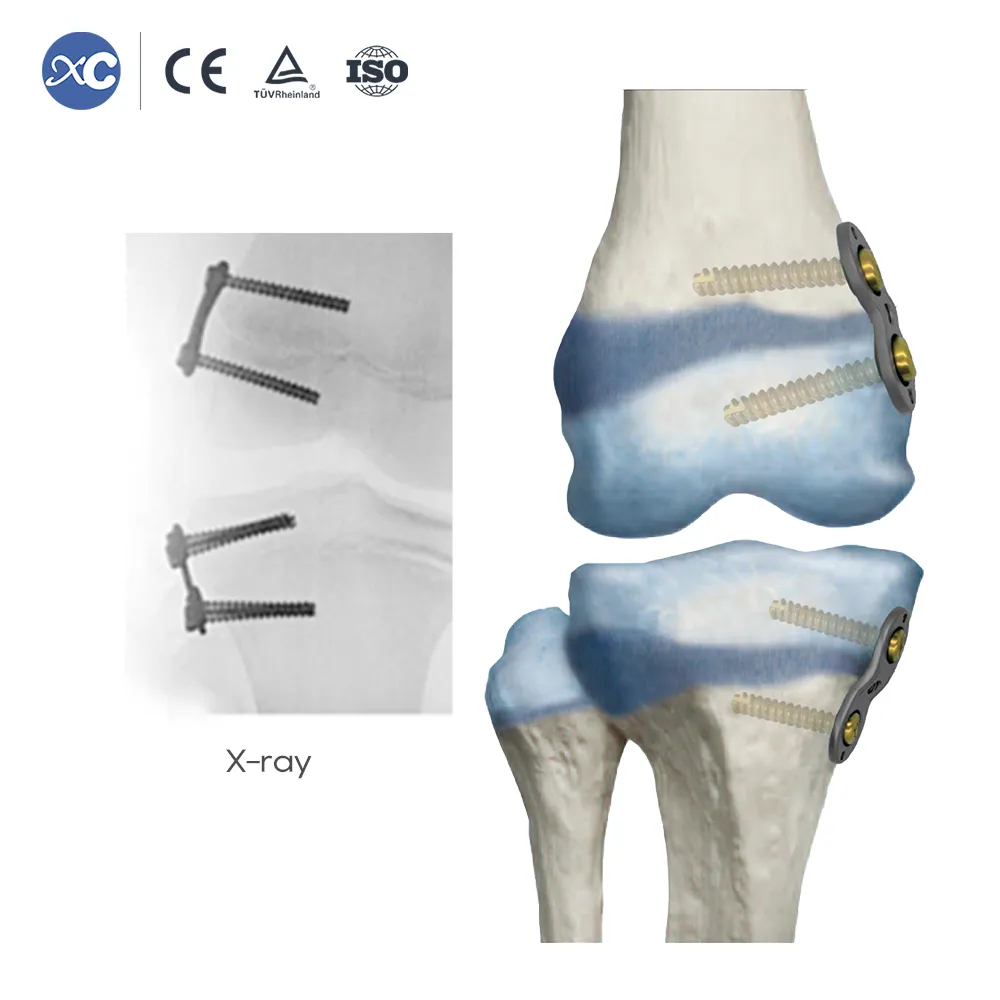Pediatric Valgus Varus Orthopedic Instrument Set - 5
