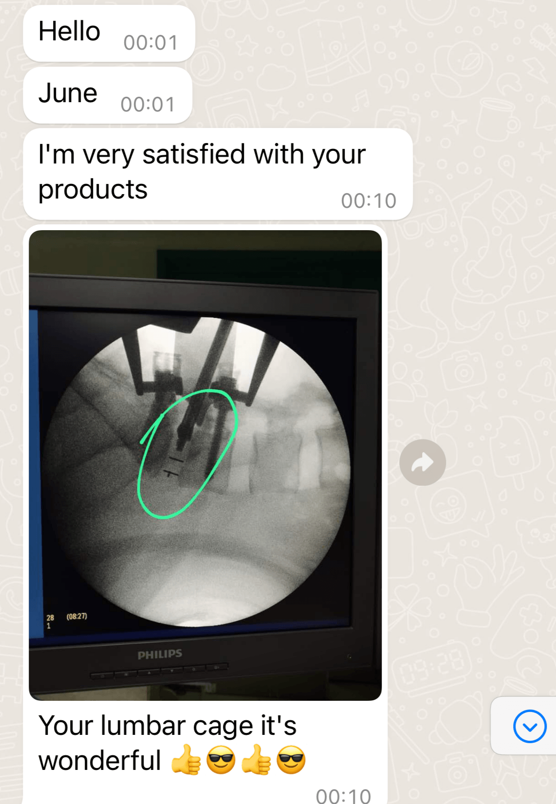 C-arm fluoroscopy image during TLIF procedure showing clear tantalum marker visualization on lumbar interbody cage