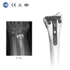 Distal Radius Volar Multi-axial Locking Plate | Titanium Orthopedic Implants & Fracture Fixation