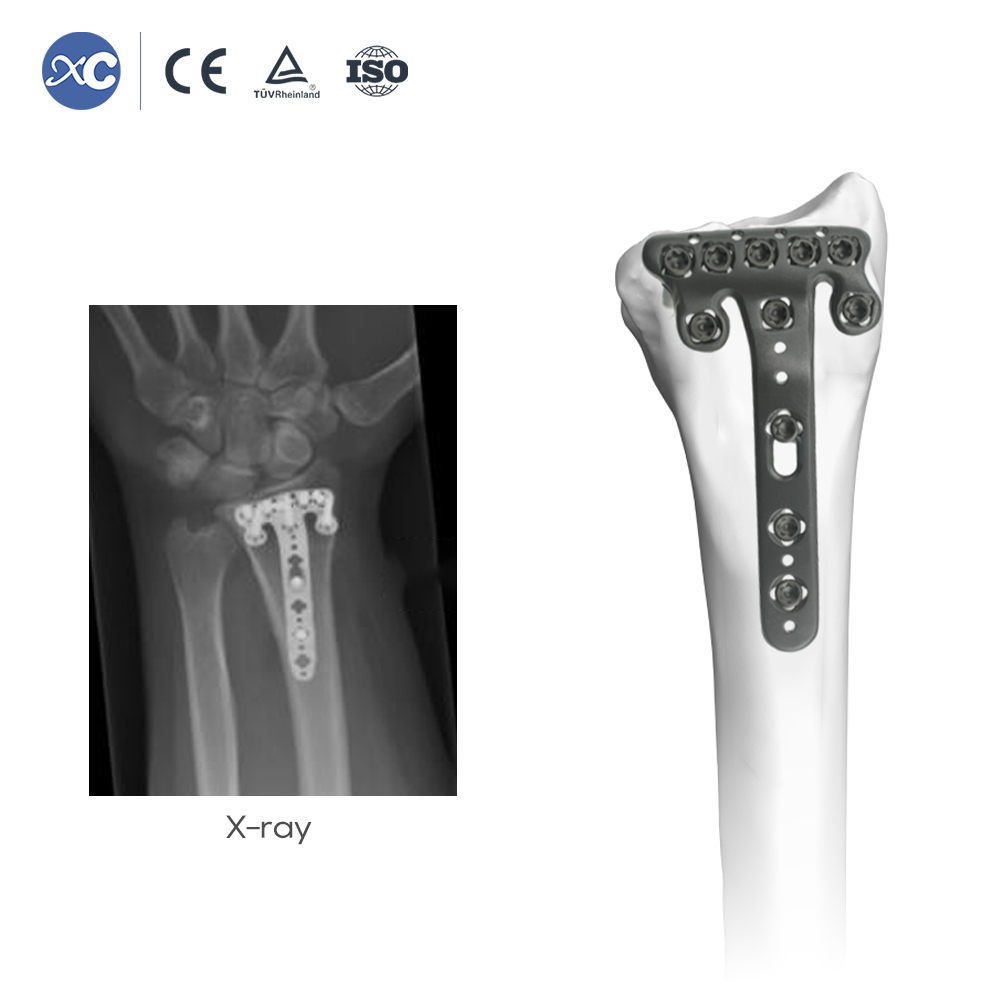 Distal Radius Volar Multi-axial Locking Plate | Titanium Orthopedic Implants & Fracture Fixation